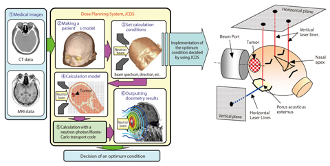 Fig.12-5 The Process flow of dosimetry by JCDS(right)Fig.12-6 Patient immobilization method using laser beams(left)