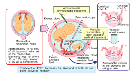 Fig.11-7 Example of congenital disease: Twin-to-Twin Transfusion Syndrome (TTTS)