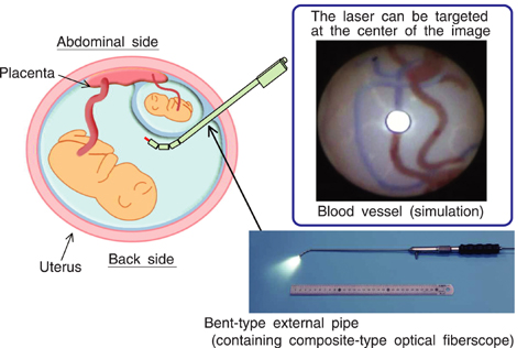 Fig.11-9 Technology that enables placenta treatment at all positions