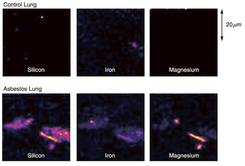 Fig.14-22 Pulmonary tissue taken from lung cancer patients with and w/o asbestos