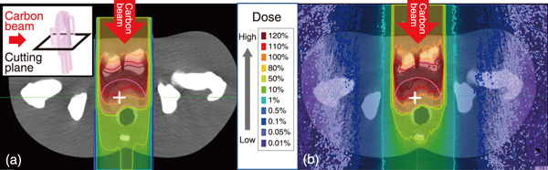 Fig.1  Comparison of dose distribution in anthropomorphic phantom between (a) the conventional calculation and (b) RadioTherapy package based on Particle and Heavy Ion Transport code System (RT-PHITS) for carbon ion radiotherapy (CIRT)