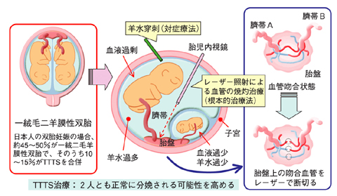 図11-7　先天性疾患：双胎間輸血症候群（TTTS）