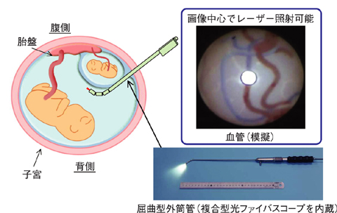 図11-9　あらゆる位置での胎盤治療を可能とする技術
